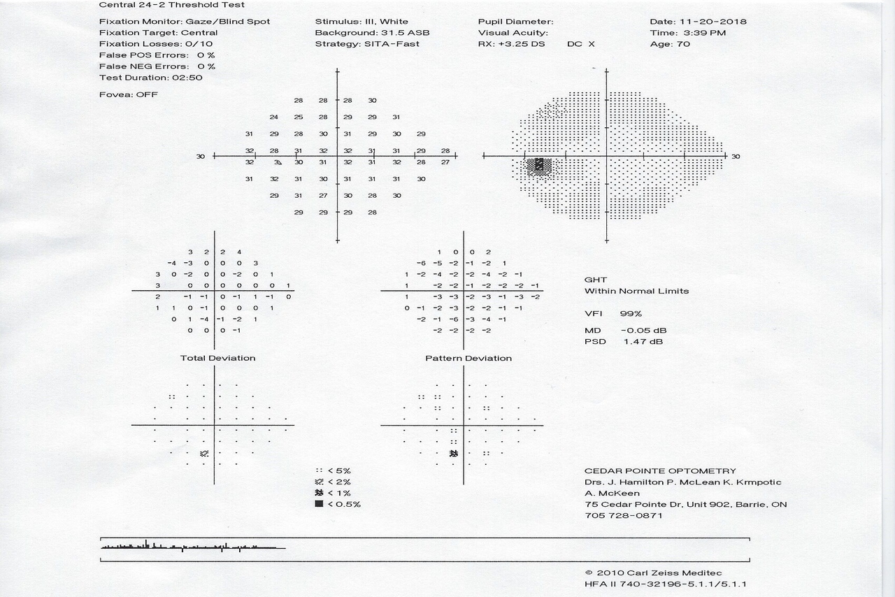 visual-fields-cedar-pointe-optometry-stayner-optometry-clinics